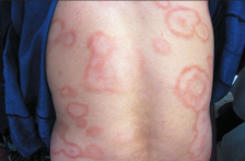 За прв пат по повеќе од 40 години Романија потврди два случаи на лепра