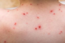 Канада го изгуби статусот земја без сипаници по речиси три децении