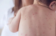 Епидемија на мали сипаници во северен Лондон | Сител Телевизија